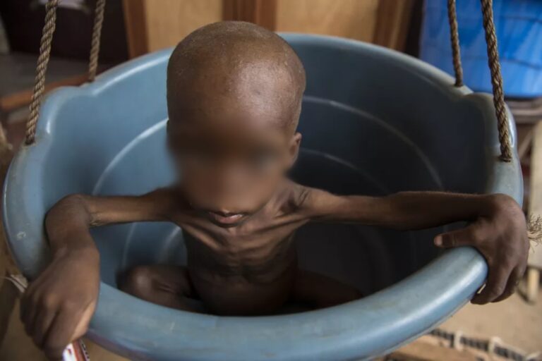 Ituri : 52% de la population est touchée par la malnutrition chronique dans la province